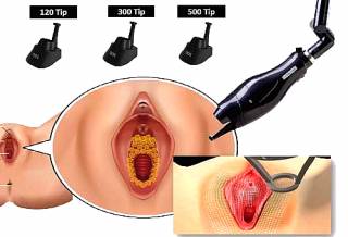 Fractional Laser με γυναικολογικές κεφαλές eCO2 Plus